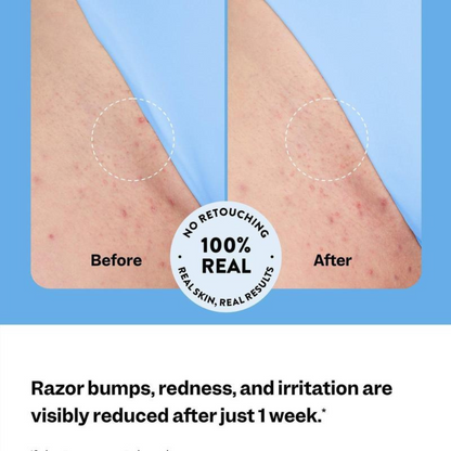Smoothing Solution Roller Treatment